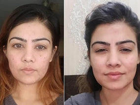 women with skin problem cured using truly komal products