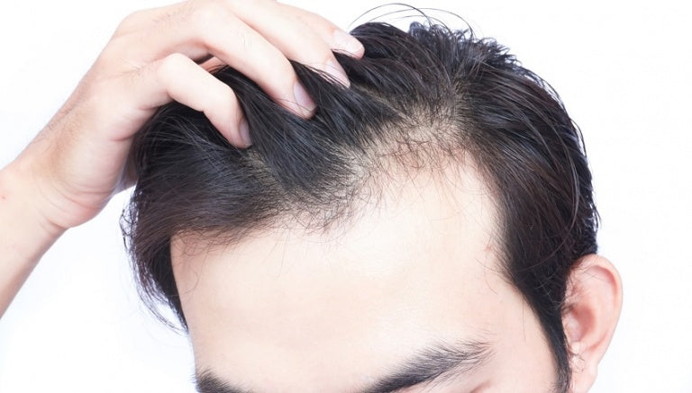 CAUSES OF HAIR LOSS IN MEN AND HOW TO AVOID IT