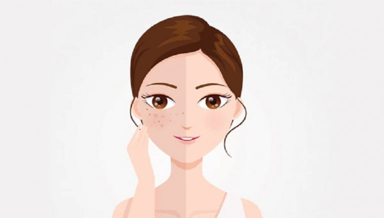PIGMENTATION AND HOW TO GET RID OF IT.