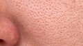 Open Pores
