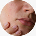 Redness and Sensitivity