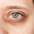 Dark circles