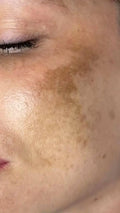 hyperpigmentation