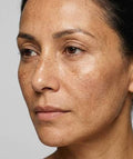 Uneven skin tone